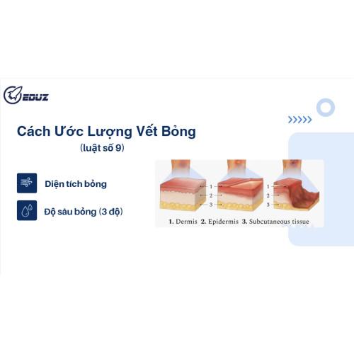 2. Cách ước lượng vết bỏng